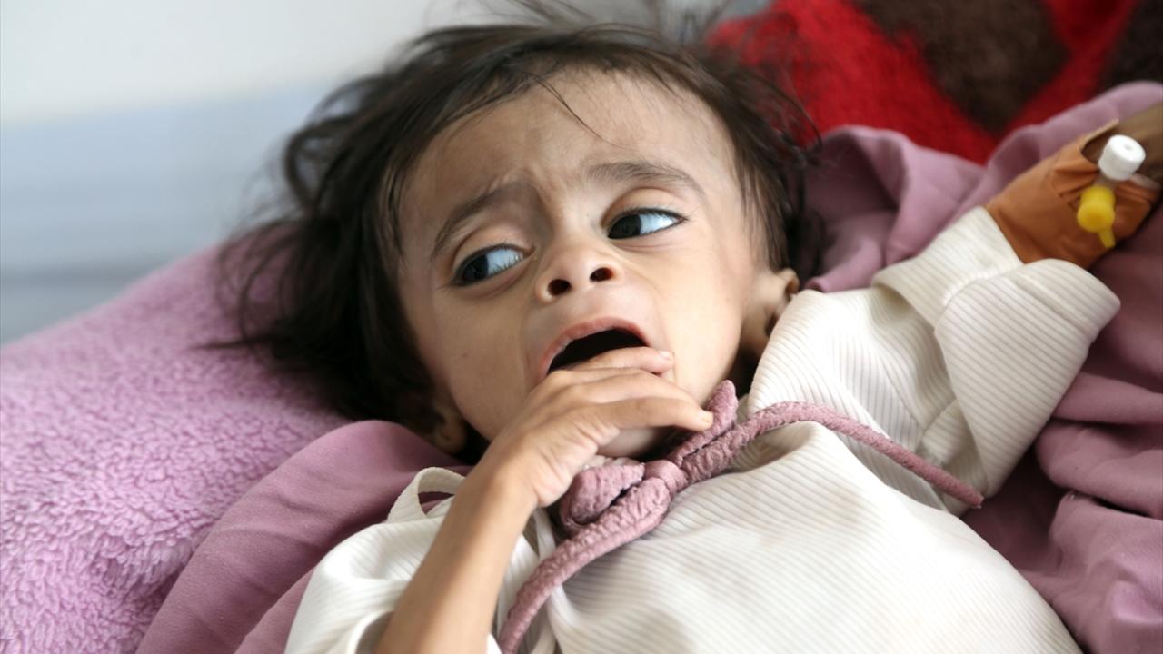 yemen-yetersiz-beslenme-aa-2477710.jpg
